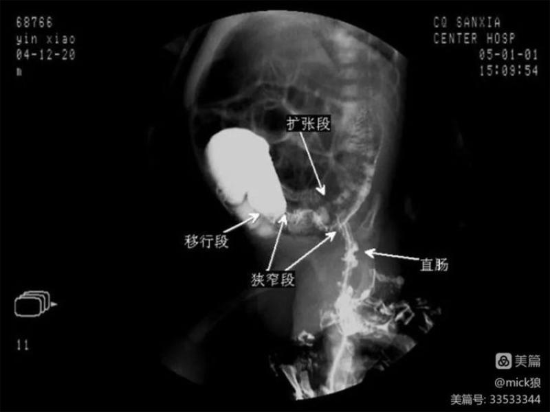 女子在家自行灌腸引發(fā)水中毒事件，深度解析與警示